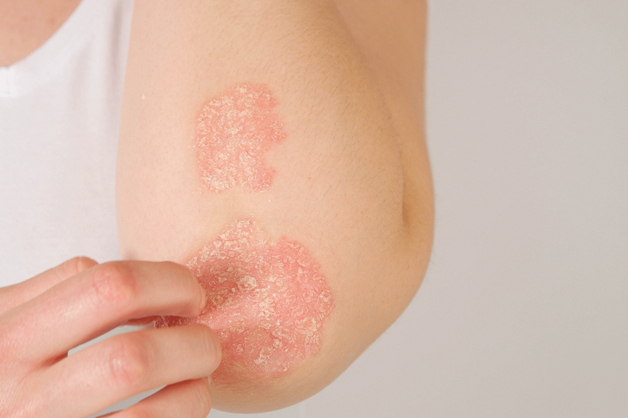 epsom-salt-for-eczema